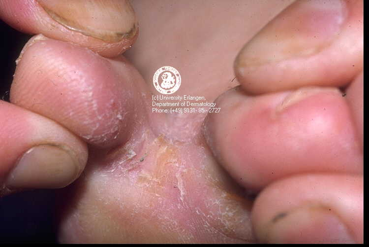 Por que salen hongos en las uñas de los pies
